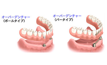 オーバーデンチャー