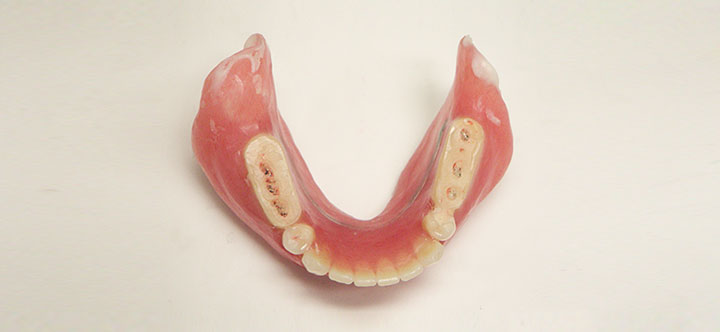 治療用義歯