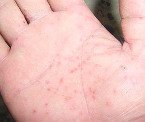 金属アレルギー