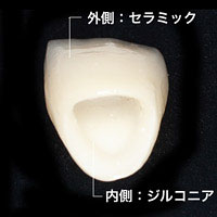 ジルコニアセラミック