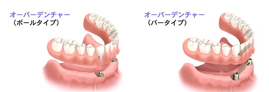 オーバーデンチャー