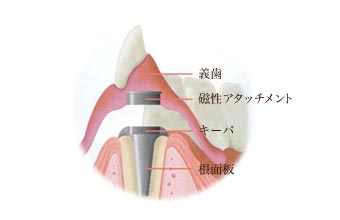 磁性アタッチメント